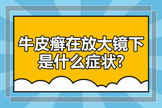 儿童患了牛皮癣之后有什么治疗方法可以使用